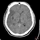IQon Spectral CT: Improving Patient Management in Neurology