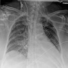 Reducing errors in portable chest radiography