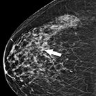 Stereotactic breast biopsies: An update in the era of digital tomosynthesis