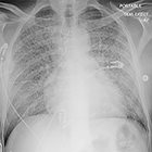 Sponge Lung: Pulmonary edema superimposed on emphysema