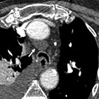 A Multimodality Approach to Imaging the Mediastinum and Pleura: Pearls and Pitfalls