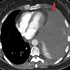 Pleural Disease: A Review for the General Radiologist