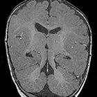 Radiological Case: Joubert syndrome