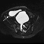 Currarino syndrome and the effect of a large anterior sacral meningocele on distal colostogram in an anorectal malformation