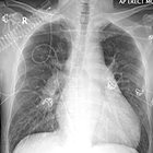 Pulmonary Veno-Occlusive Disease and the Role of the Radiologist