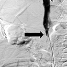 Leiomyosarcoma of the Inferior Vena Cava