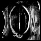 Atretic cephalocele: Prenatal and postnatal imaging features