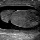 Neonatal juvenile granulosa cell tumor of the testis