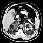 Giant bilateral hemorrhagic adrenal myelolipomas