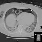 Radiological Case: Nonsurgical pneumoperitoneum