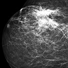 Benign breast lesions that mimic cancer: Determining radiologic-pathologic concordance