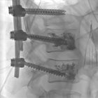 Percutaneous vertebroplasty: Overview, clinical applications, and current state
