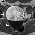 Ovarian Masses and O-RADS: A Systematic Approach to Evaluating and Characterizing Adnexal Masses with MRI