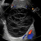 Ovarian Masses and O-RADS: A Systematic Approach to Evaluating and Characterizing Adnexal Masses with Ultrasound
