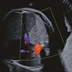 Multimodality Evaluation of Fetal Congenital Diaphragmatic Hernia and Its Mimics