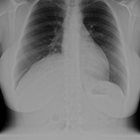 Thoracic Outlet Syndrome: Review of Surgical Approaches and Radiographic Complications