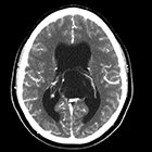 Radiological Case: Lateral ventricle epidermoid