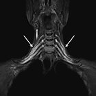 Radiation-induced brachial plexopathy