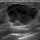 Primary Breast Lymphoma 