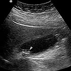 Applied hepatobiliary scintigraphy in acute cholecystitis