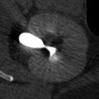 Pitfalls in MDCT urography
