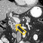 Biliary tract emergencies: What the radiologist should know