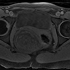 Radiological Case: Retrorectal cystic hamartoma (Tailgut cyst)