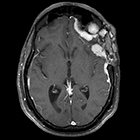 Radiological Case: Metastatic meningioma