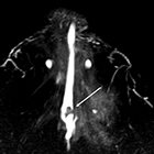 Small Coil MRI of the Nipple-Areola Complex and Retroareolar Breast