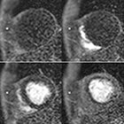 Cardiac MRI: A preferred method for assessing myocardial ischemia and infarct burden