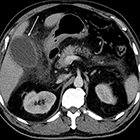 Acute perforated acalculous cholecystitis