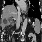Intrahepatic biloma from ruptured cholecystitis