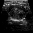 Radiological Case: Intussusception