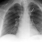 Metastatic pulmonary calcification