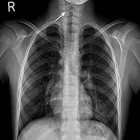 A radiolucent esophageal foreign body: Diagnosis, management, and potential complications