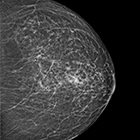 Breast amyloidosis detected with 3D mammography