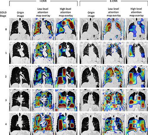 Deep Learning Model Helps Detect Lung Tumors Using CT Scans | Applied ...