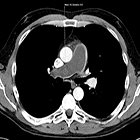 Liposarcoma presenting as a pulmonary embolism with right-sided cardiac strain