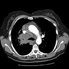 Radiological Case: Denosumab-related osseous sclerotic response in metastatic small cell carcinoma of the lung
