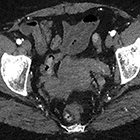 Radiological Case: Intravenous leiomyomatosis