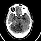 Acute presentation of Lhermitte-Duclos disease in an adult patient in association with Cowden syndrome