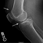 Anterior Cruciate Ligament and Meniscal Tears: A Multi-modality Review