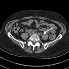 Primary localized ureteral amyloidosis mimicking urothelial carcinoma