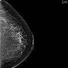An overview of breast MRI