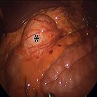 Duplication cyst of the transverse colon