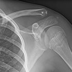 Imaging Upper Extremity Injuries in Pediatric Athletes