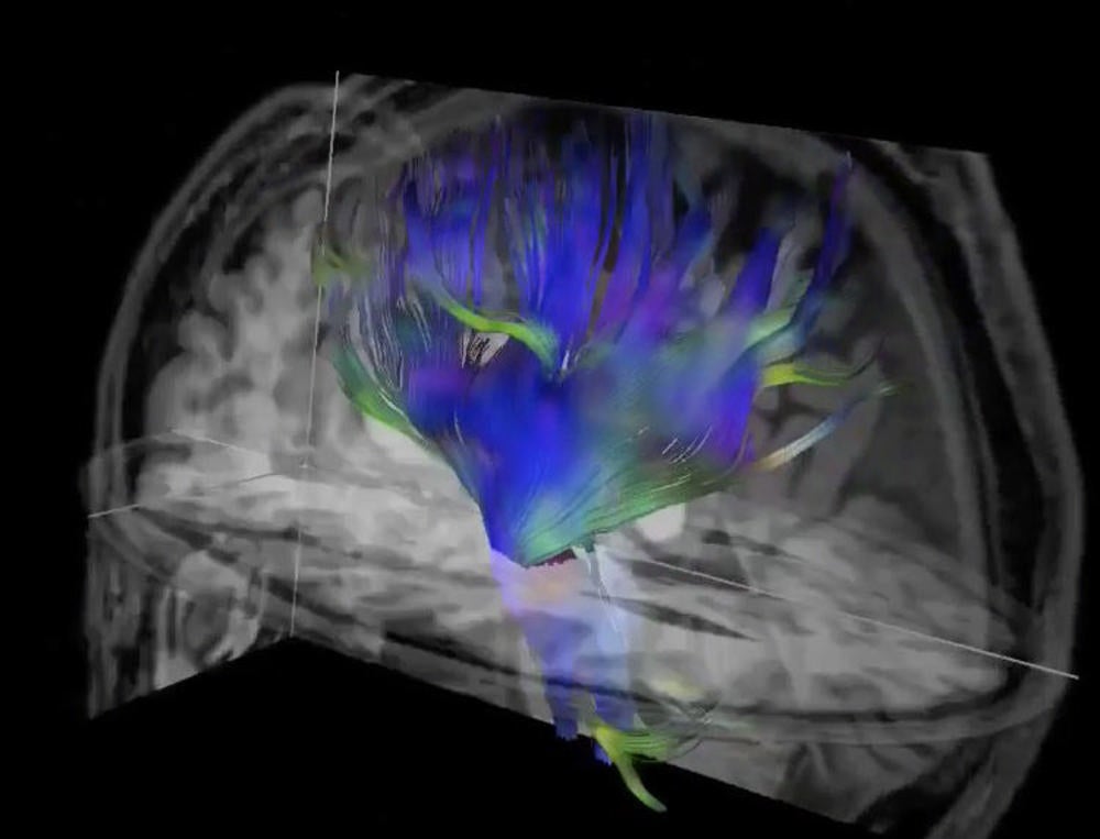 Soccer Heading Causes Damage in Brain Regions Affected in CTE | Applied ...