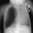 Pediatric chest: A review of the must-know diagnoses