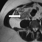 MRI in pregnancy: Gastrointestinal and genitourinary pathology