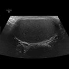 Polyorchidism with intermittent testicular torsion